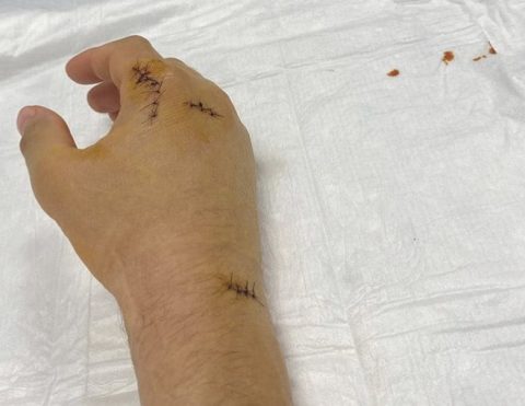 Fredrik Lindgren przeszedł operację dłoni. „Dowiedziałem się, że jest znacznie gorzej, niż się spodziewałem”