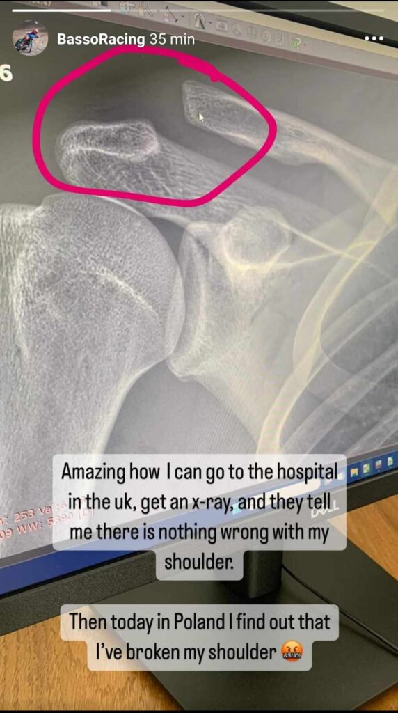 Żużel. Zawodnik Orła kontuzjowany! Uraz zdiagnozowano dopiero w Polsce 1 450548528 1183795469335560 7922843837179148120 n e1721478339384